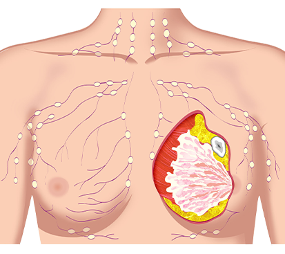 Breast Abscess surgery in Mogappair