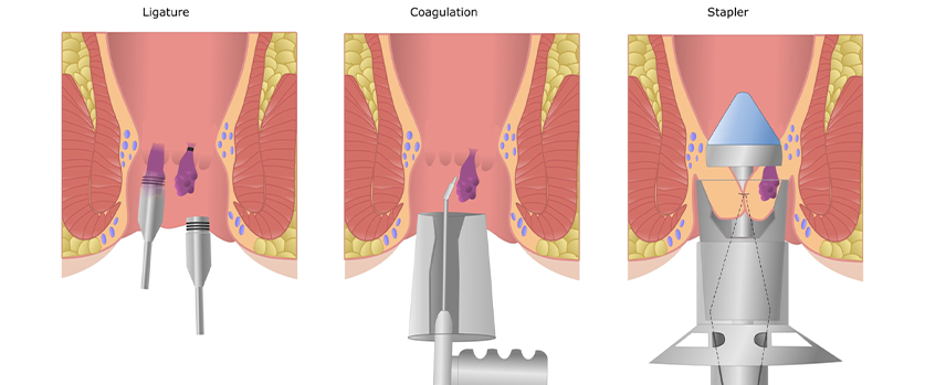 Colloid Goitre Surgery in Kolathur