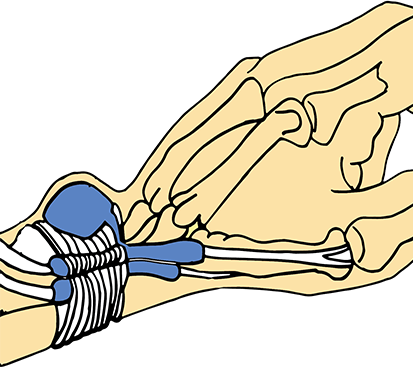 Ganglion Cyst Surgery in Mogappair