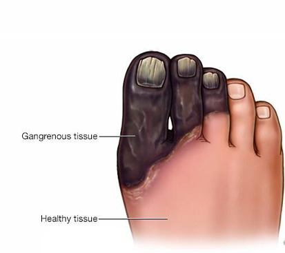 Gangrene Foot Treatment in Kolathur