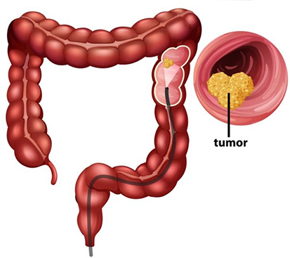 Colorectal Cancer Treatment in Mogappair