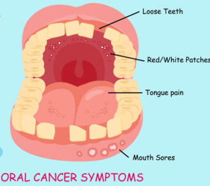Oral Cavity Cancer Treatment Cost in Mogappair