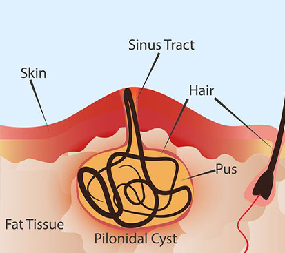 Pilonidal Sinus Surgery in Mogappair