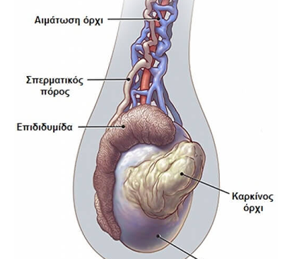 Testicular Torsion Surgery in Mogappair