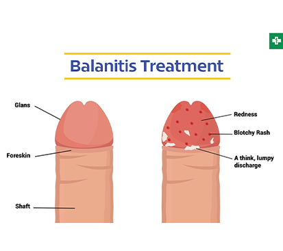 Balanitis and Balanoposthitis Treatment in Mogappair
