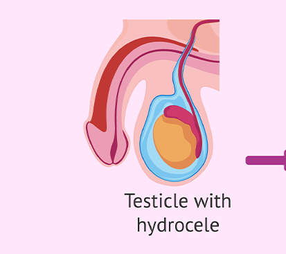 Phimosis Surgery in Kolathur