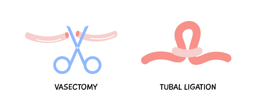 Vasectomy Surgery in Kolathur