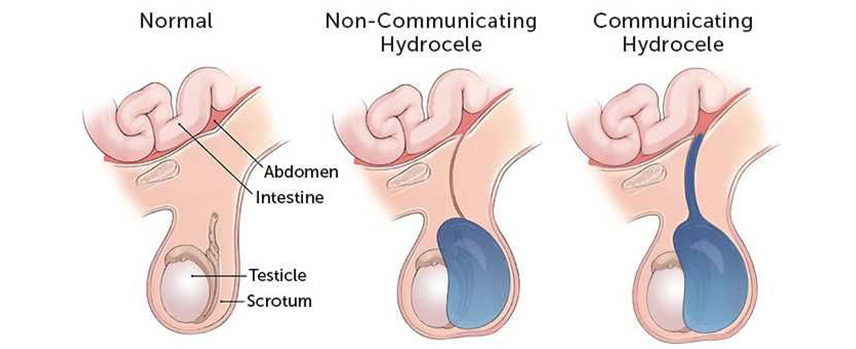 Hydrocele Treatment in Kolathur