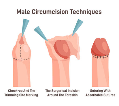 Paraphimosis Treatment in Kolathur