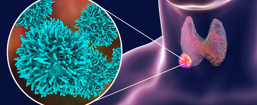 Thyroid Nodule Surgery in Kolathur