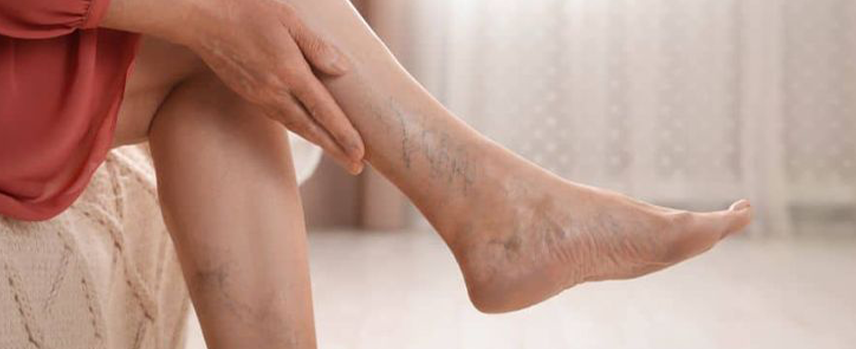 Varicose Veins Treatment in Mogappair