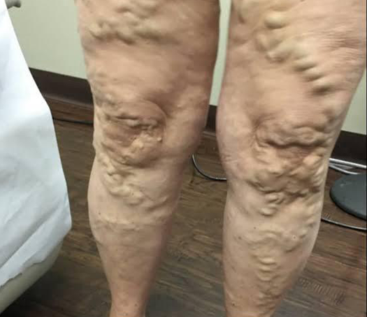 Vericose Veins Treatment in Kolathur